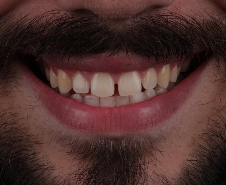 Sorriso antes do tratamento com facetas em resina