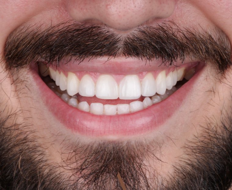 Sorriso depois do tratamento com facetas em resina